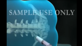 Epidural Spinal Anesthesia