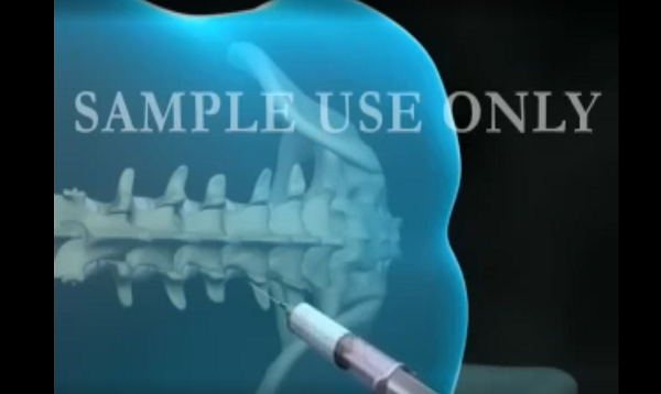 Epidural Spinal Anesthesia