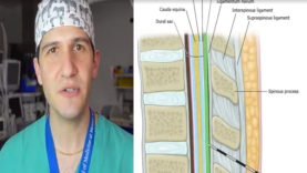 Epidural, spinal, and combined spinal-epidural overview