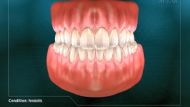 Periodontitis – Gum Disease