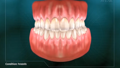 Periodontitis – Gum Disease
