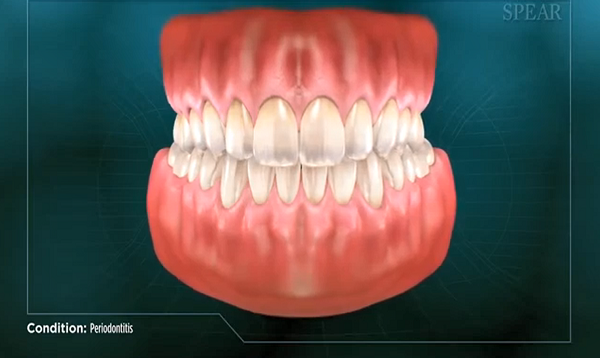 Periodontitis – Gum Disease
