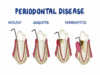 Risk Factors for Periodontitis