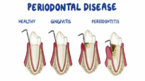 Risk Factors for Periodontitis