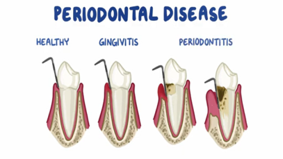 Risk Factors for Periodontitis