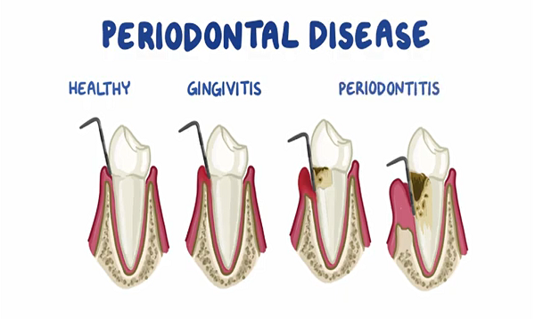 Risk Factors for Periodontitis