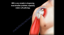 Rotator Cuff MRI Everything You Need To Know