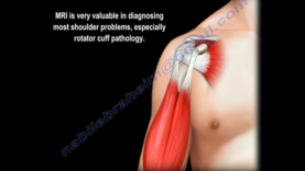 Rotator Cuff MRI Everything You Need To Know