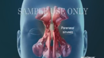 Sinusitis Surgery