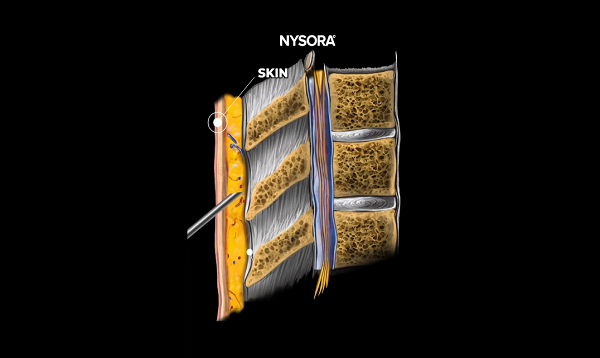 Spinal Anesthesia Layers