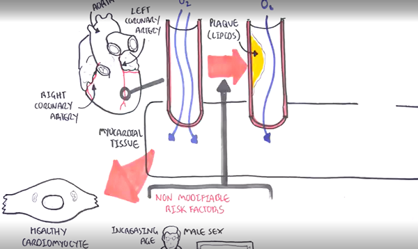 Acute Coronary Syndrome DETAILED Overview