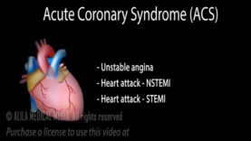 Acute Coronary Syndrome Unstable Angina