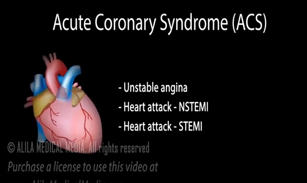 Acute Coronary Syndrome Unstable Angina