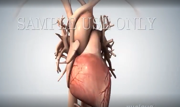 Acute Coronary Syndrome and Heart Attack