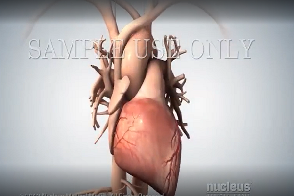 Acute Coronary Syndrome and Heart Attack