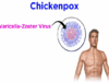 Chickenpox and Shingles (Varicella-Zoster Virus)