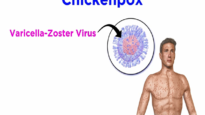 Chickenpox and Shingles (Varicella-Zoster Virus)