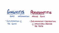 Gingivitis and periodontitis causes, symptoms, diagnosis, trea