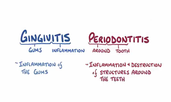 Gingivitis and periodontitis causes, symptoms, diagnosis, trea