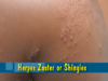 Herpes Zoster or Shingles