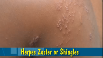 Herpes Zoster or Shingles