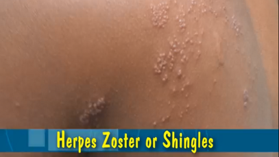 Herpes Zoster or Shingles