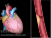 Myocardial Infarction and Coronary Angioplasty Treatment