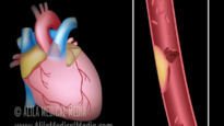 Myocardial Infarction and Coronary Angioplasty Treatment
