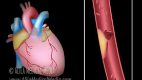 Myocardial Infarction and Coronary Angioplasty Treatment