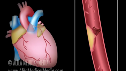 Myocardial Infarction and Coronary Angioplasty Treatment
