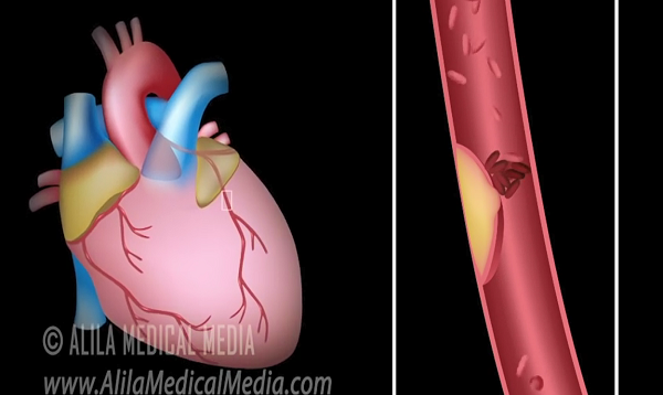 Myocardial Infarction and Coronary Angioplasty Treatment