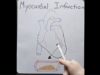 Myocardial Infarction in 2 mins!