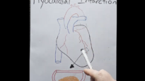 Myocardial Infarction in 2 mins!
