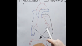 Myocardial Infarction in 2 mins!