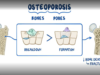 Osteoporosis causes, symptoms, diagnosis, treatment, pathology