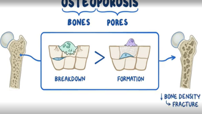 Osteoporosis causes, symptoms, diagnosis, treatment, pathology