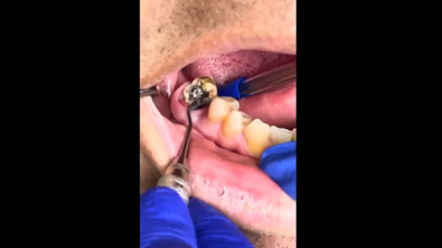 Rotten tooth under the Old Crown