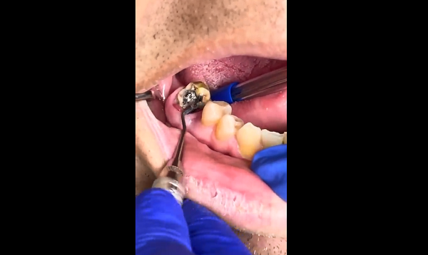 Rotten tooth under the Old Crown
