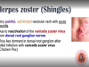 Shingles Herpes Zoster Pathophysiology, Risk Factors, Phases