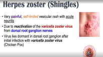 Shingles Herpes Zoster Pathophysiology, Risk Factors, Phases