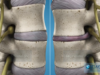What Is Lumbar Degenerative Disc Disease Intervertebral Disc
