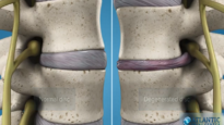 What Is Lumbar Degenerative Disc Disease Intervertebral Disc