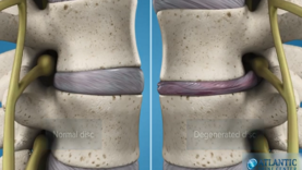 What Is Lumbar Degenerative Disc Disease Intervertebral Disc