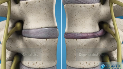What Is Lumbar Degenerative Disc Disease Intervertebral Disc