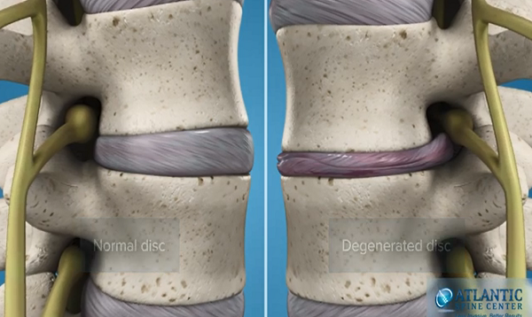 What Is Lumbar Degenerative Disc Disease Intervertebral Disc