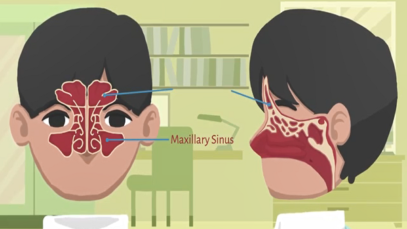 What is Sinusitis
