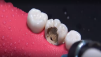 AMAZING reconstruction of tooth damaged by caries Endodontics