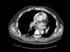 Abdomen Pelvis CT Pyogenic Liver Abscess
