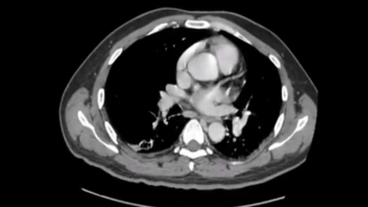 Abdomen Pelvis CT Pyogenic Liver Abscess