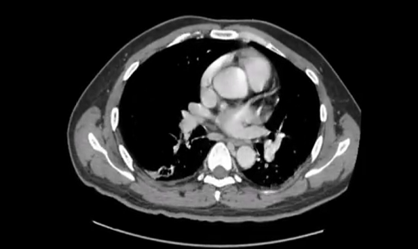Abdomen Pelvis CT Pyogenic Liver Abscess